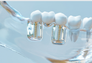 dental implants expert Adelaide