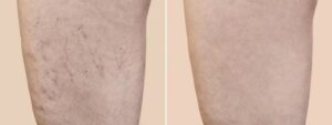 varicose vein treatment Adelaide